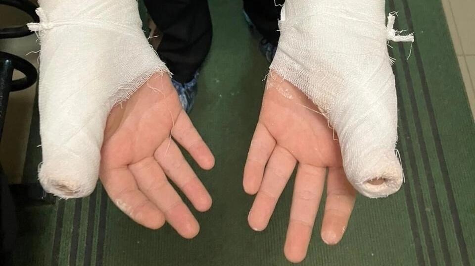 Ученику одной из школ Вологды сломали руки, вымогая деньги